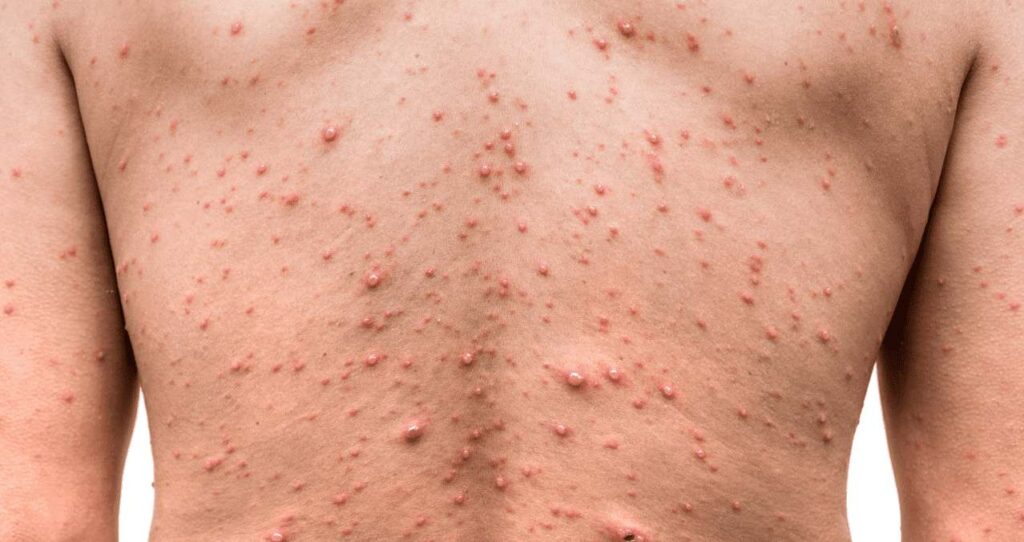 Alerta en Salta: Se confirmaron 2 casos autóctonos de viruela del mono - Revista Salvador