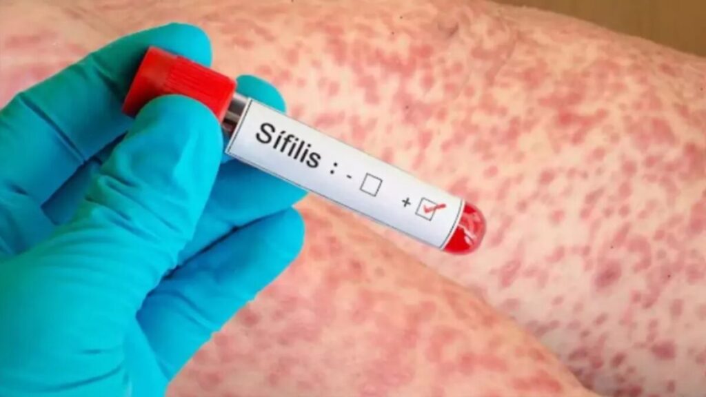 Alarma por el aumento de los casos de sífilis en el país - Revista Salvador