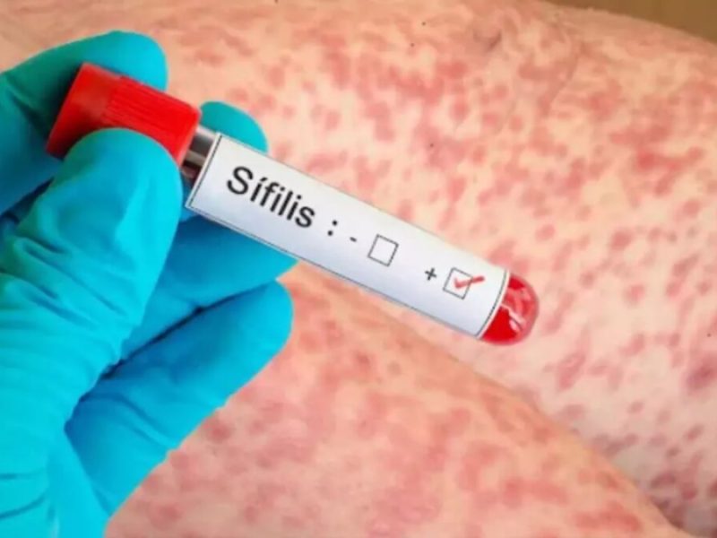 sifilis
